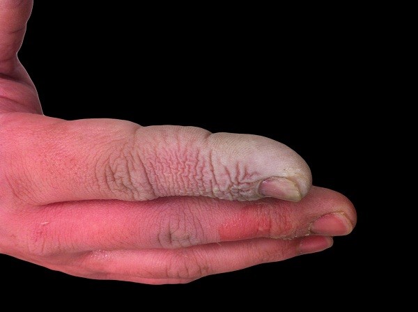 HỎI VỀ ĐIỀU TRỊ SAU BỎNG